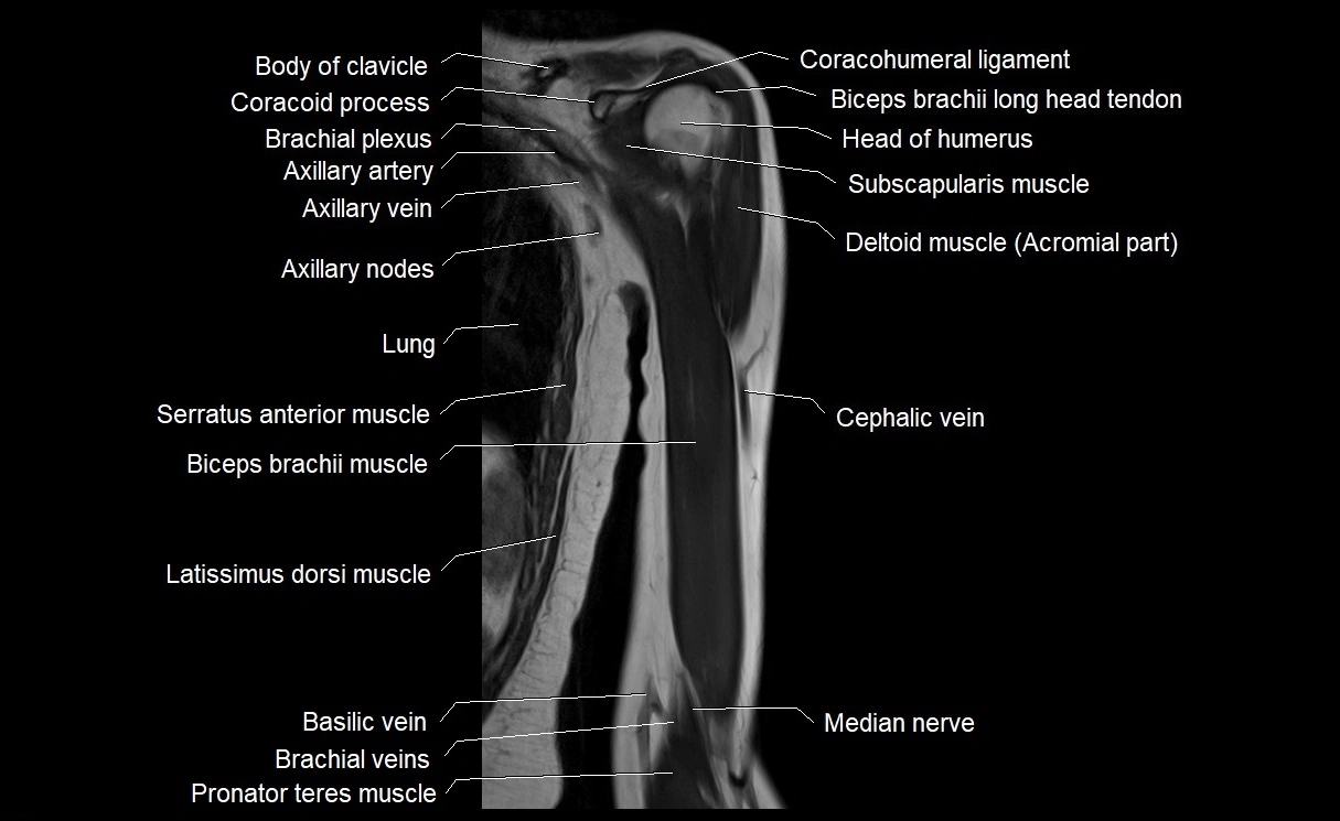 MRI upper arm (humerus ) coronal cross sectional anatomy image 8.webp